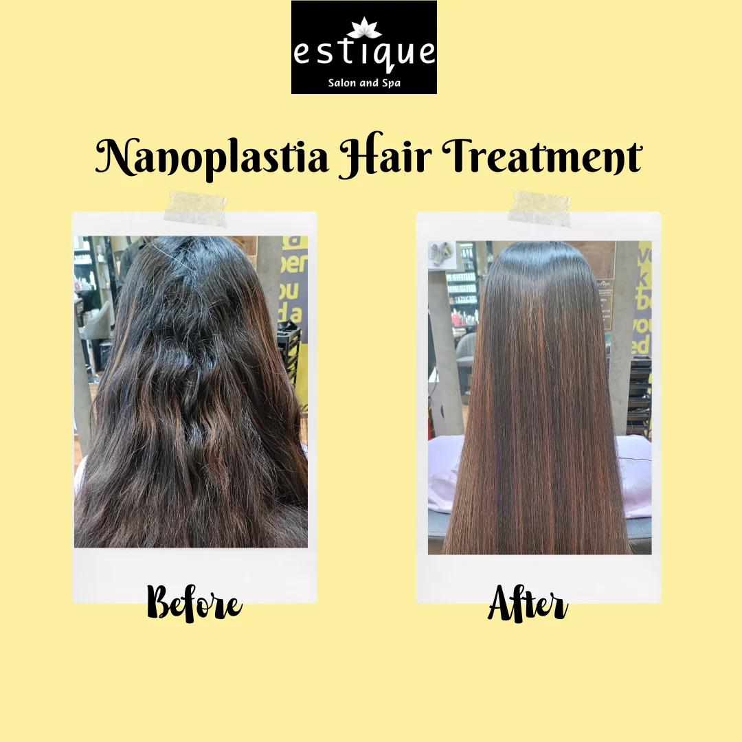 Nanoplastia Treatment in Vasant Vihar